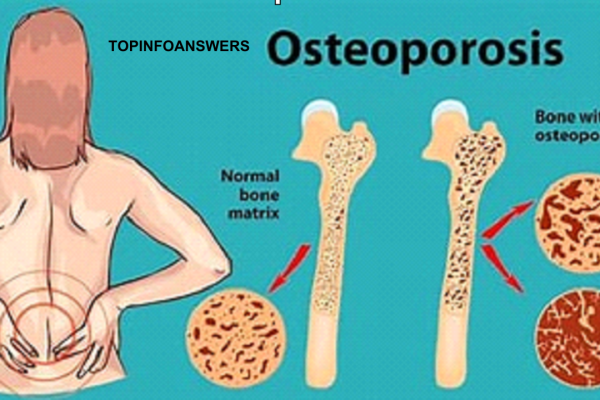 How to Prevent or Manage Osteoporosis