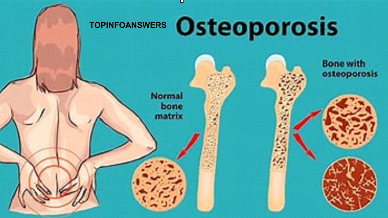 How to Prevent or Manage Osteoporosis